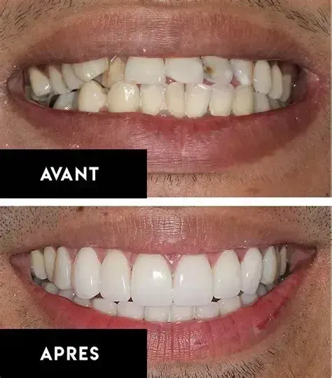 Résultat avant / après au Centre Dentaire Halim